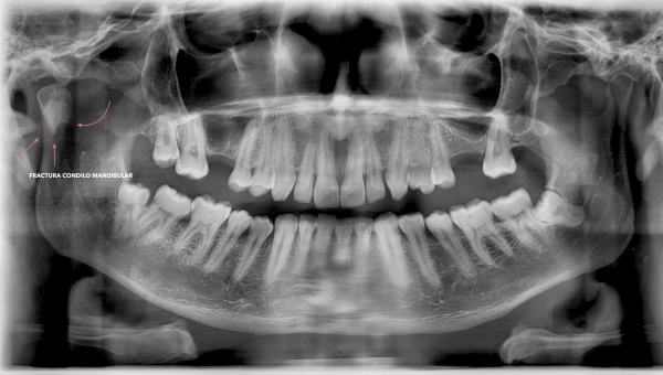 Fractura condilo mandibular - Diagnóstico radiográfico