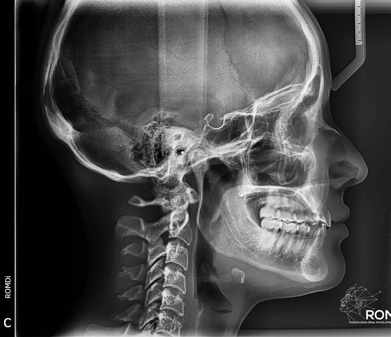 Radiografía lateral de cráneo