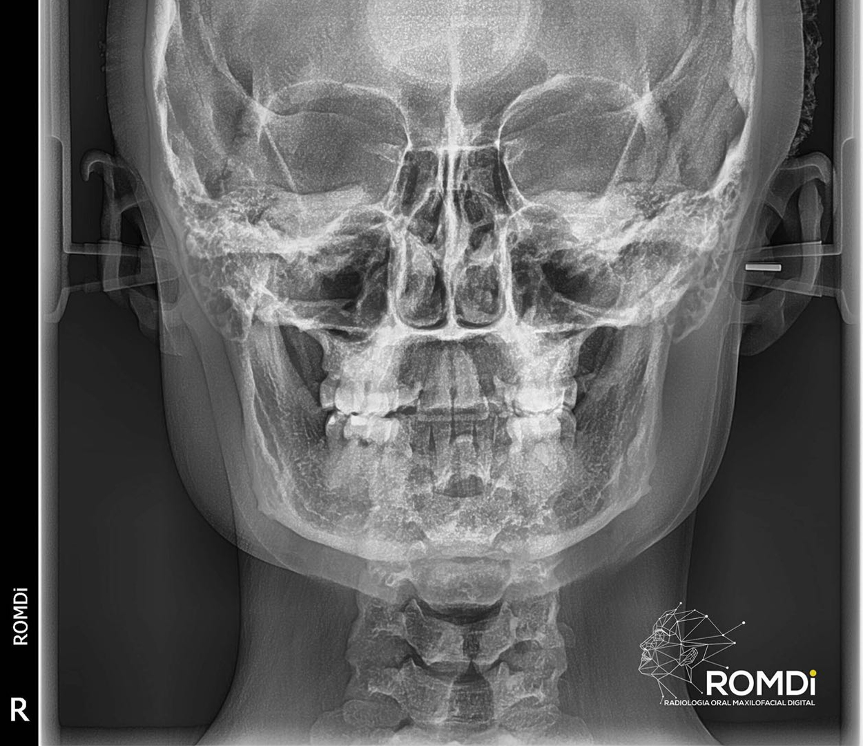 Radiografía PA de cráneo