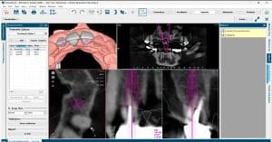 Indicaciones básicas de una tomografía dental.